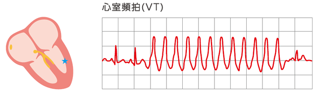 心室頻拍（VT）の画像